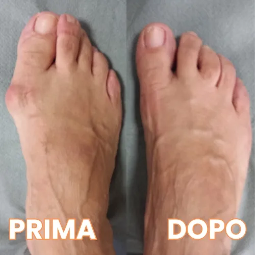 Allinea l'alluce valgo