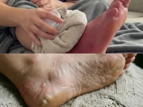 Bruciore, gonfiore e calli